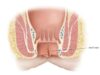 Anal Fissur Nedir? Belirtileri, Nedenleri ve Tedavi Süreci