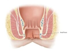Anal Fissur Nedir? Belirtileri, Nedenleri ve Tedavi Süreci