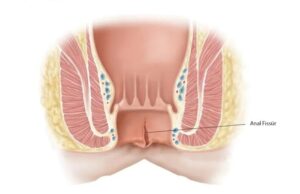 Anal Fissur Nedir? Belirtileri, Nedenleri ve Tedavi Süreci